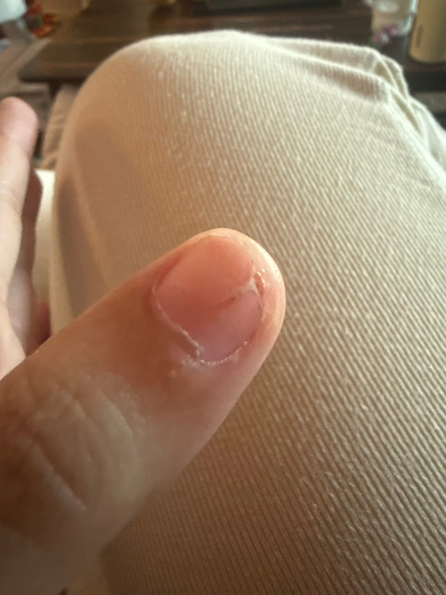 After - Nail Damage Healing