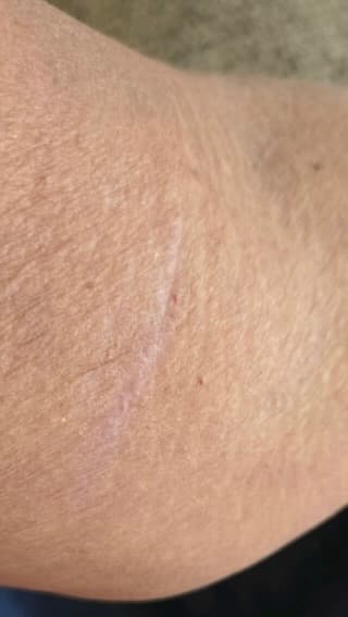 After - Scar Reduction