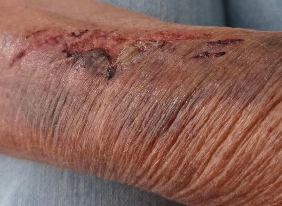 Before - Skin Wound Recovery