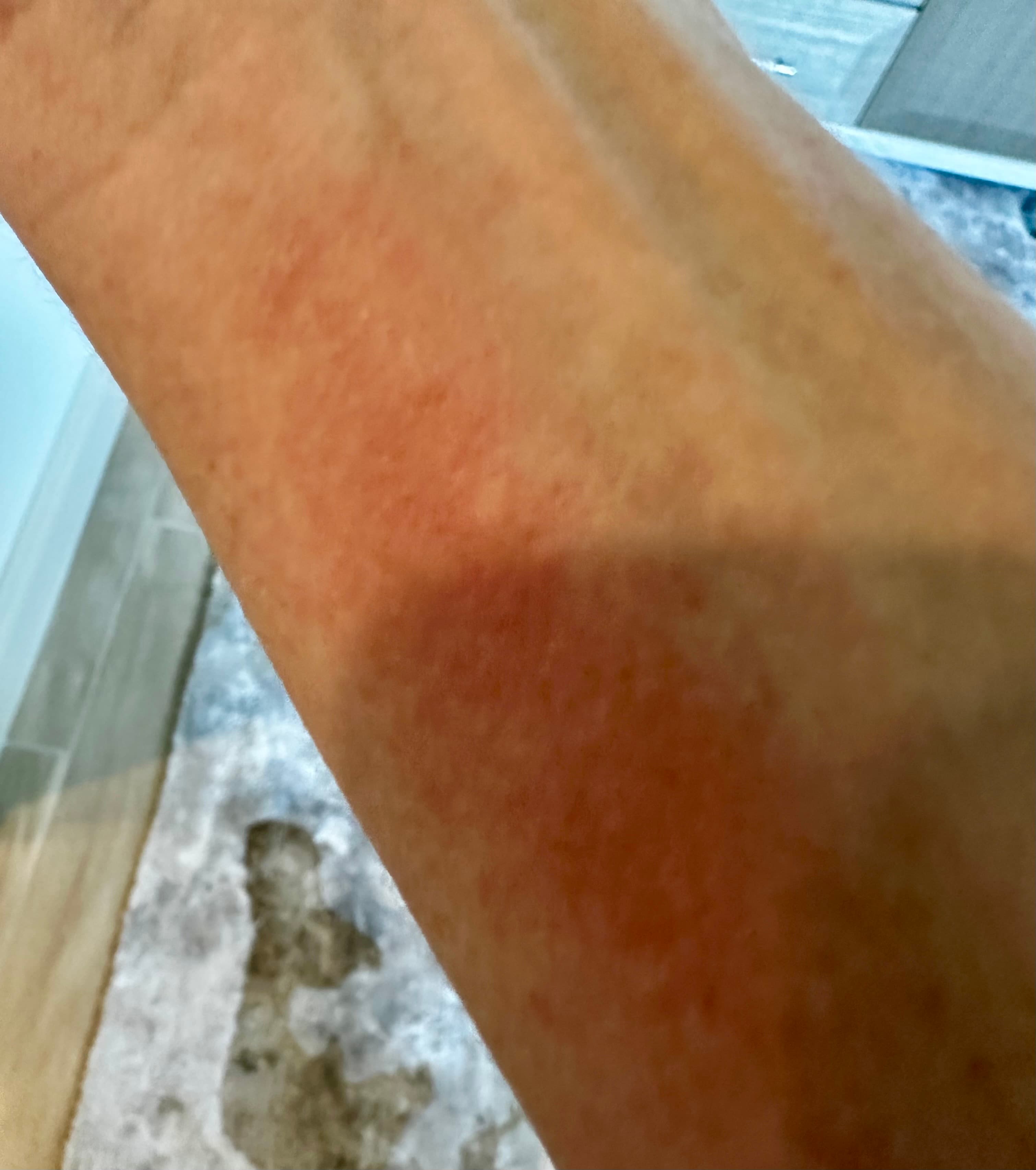 Before - Skin Irritation Relief