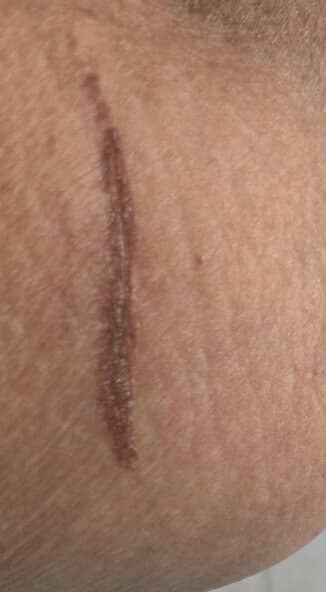 Before - Scar Reduction